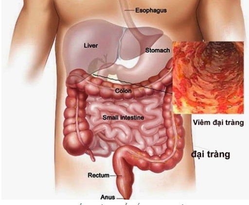 Viêm đại tràng co thắt không còn là nỗi lo