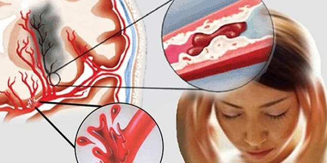 Khi đột quỵ, ung thư tìm đến người trẻ