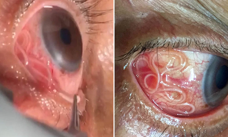 NHỮNG ĐIỀU CẦN BIẾT VỀ BỆNH MẮT DO NHIỄM KÝ SINH TRÙNG