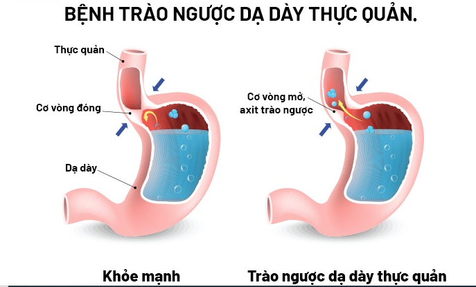 Các bệnh về đường tiêu hóa thường gặp – Nguyên nhân và triệu chứng nhận biết