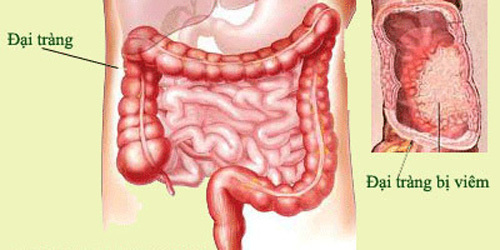 Các bệnh về đường tiêu hóa thường gặp – Nguyên nhân và triệu chứng nhận biết