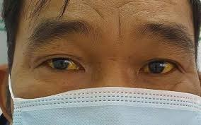 DẤU HIỆU ĐIỂN HÌNH CỦA UNG THƯ GAN BẠN CẦN BIẾT