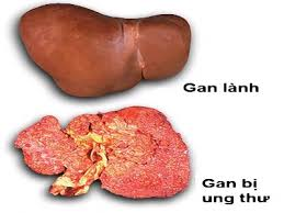 DẤU HIỆU ĐIỂN HÌNH CỦA UNG THƯ GAN BẠN CẦN BIẾT