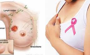 Phát hiện sớm - Chìa khóa sống còn trong cuộc chiến chống ung thư vú!