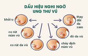 Phát hiện sớm - Chìa khóa sống còn trong cuộc chiến chống ung thư vú!