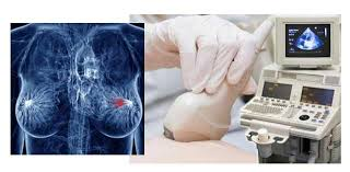 Phát hiện sớm - Chìa khóa sống còn trong cuộc chiến chống ung thư vú!