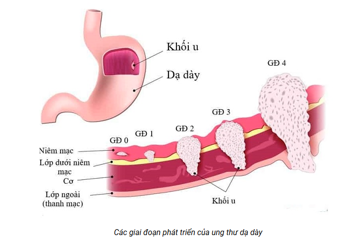 Ung thư dạ dày nguyên nhân, triệu chứng và chẩn đoán
