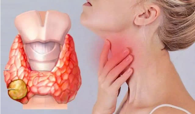 Nguyên nhân mắc bệnh u tuyến giáp