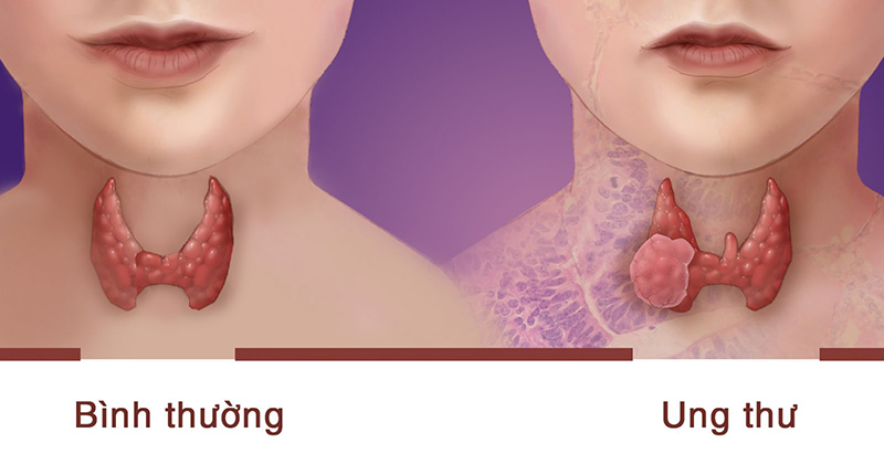 Dấu hiệu nhận biết các bệnh tuyến giáp
