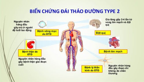 Đái tháo đường Tuýp 2