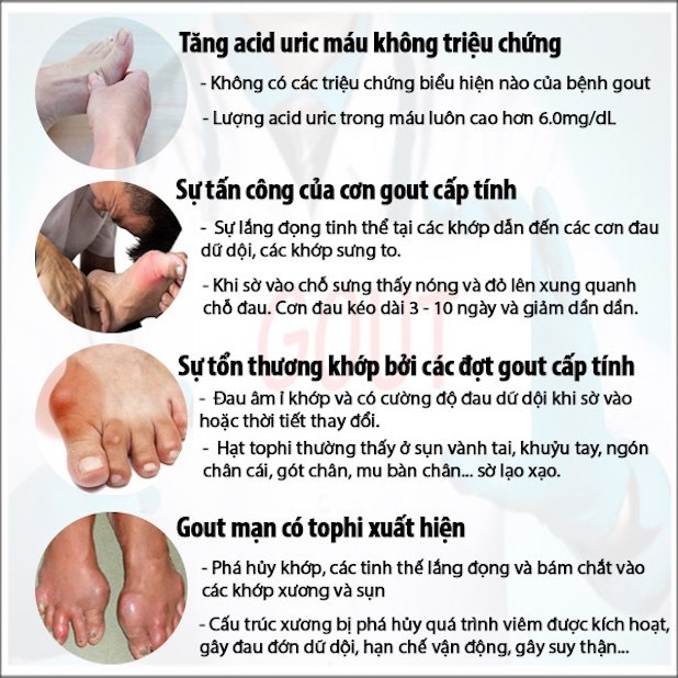 Bệnh Gout ở người trẻ - Triệu chứng nào cảnh báo bệnh Gout?