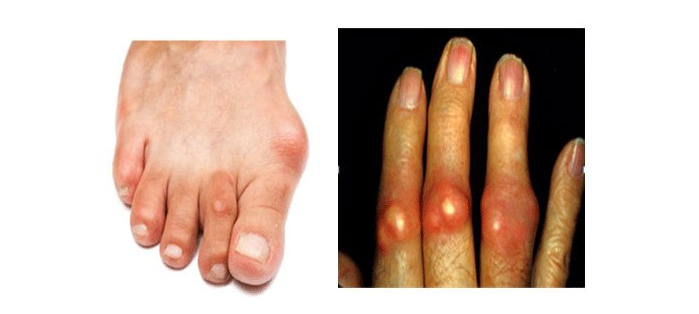 Bệnh Gout ở người trẻ - Triệu chứng nào cảnh báo bệnh Gout?