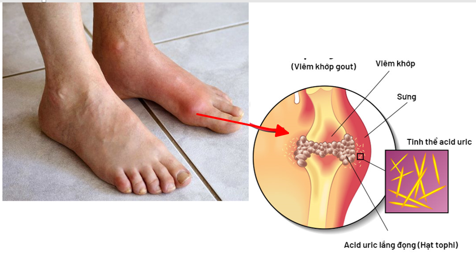 Bệnh Gout ở người trẻ - Triệu chứng nào cảnh báo bệnh Gout?