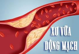 Thủ phạm gây đột quỵ, nhồi máu cơ tim!