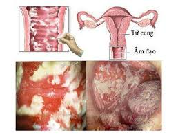 Viêm Âm Đạo — Bệnh Phụ Khoa Phổ Biến Nhưng Dễ Gây Biến Chứng Nguy Hiểm Nếu Chủ Quan!