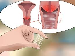 Viêm Âm Đạo — Bệnh Phụ Khoa Phổ Biến Nhưng Dễ Gây Biến Chứng Nguy Hiểm Nếu Chủ Quan!